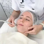 Chica recibiendo microdermoabrasión